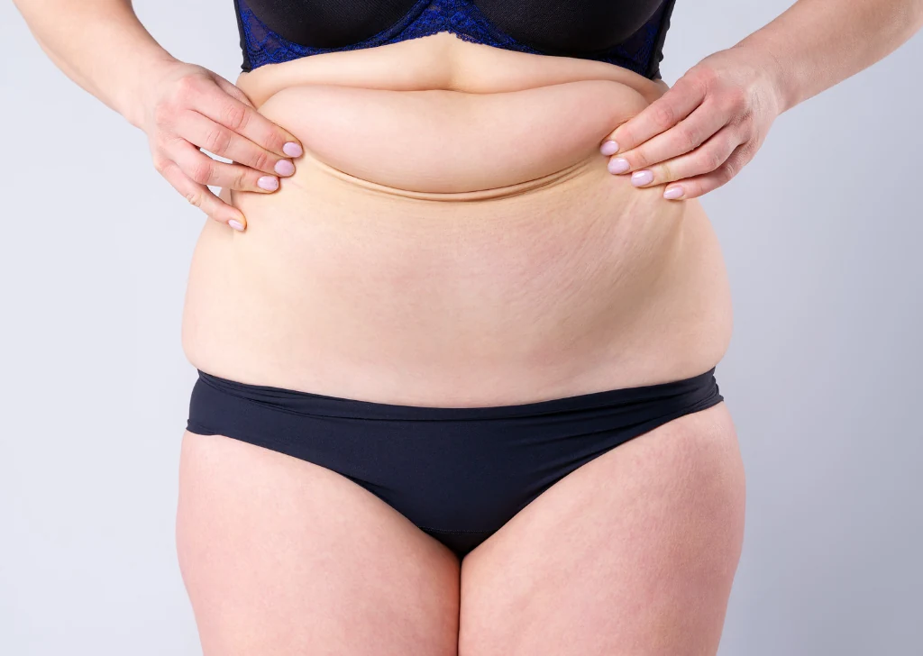 4 Questions to ask about the difference between a full tummy tuck and a mini?